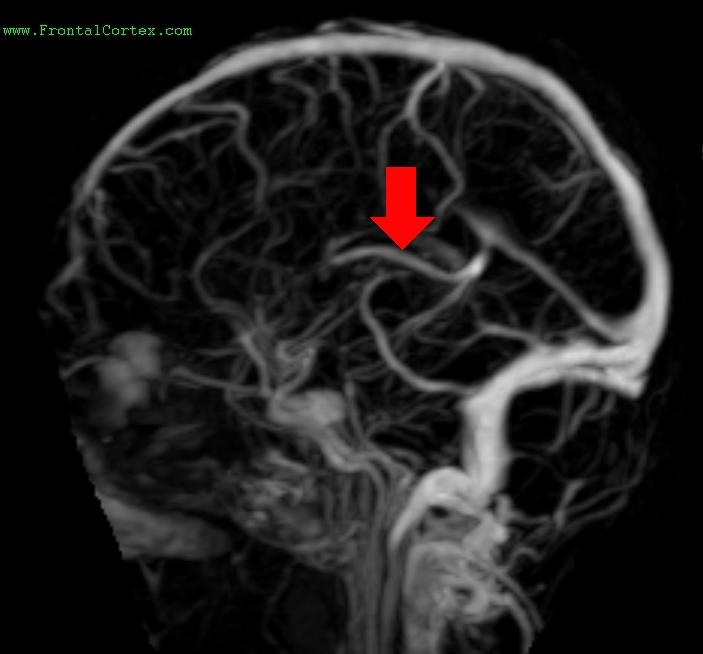 MRV Internal Cerebral Vein