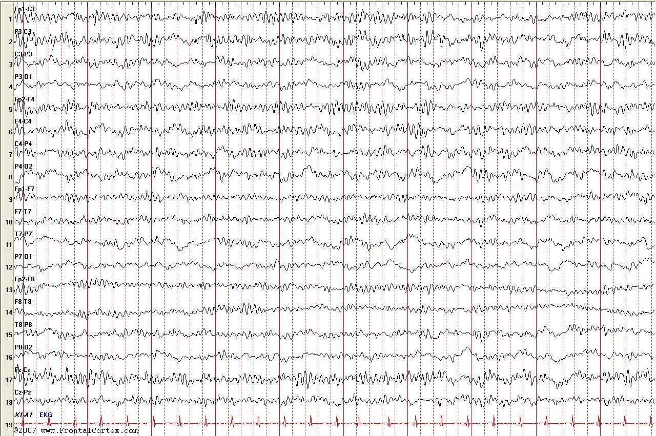 EEG alpha coma