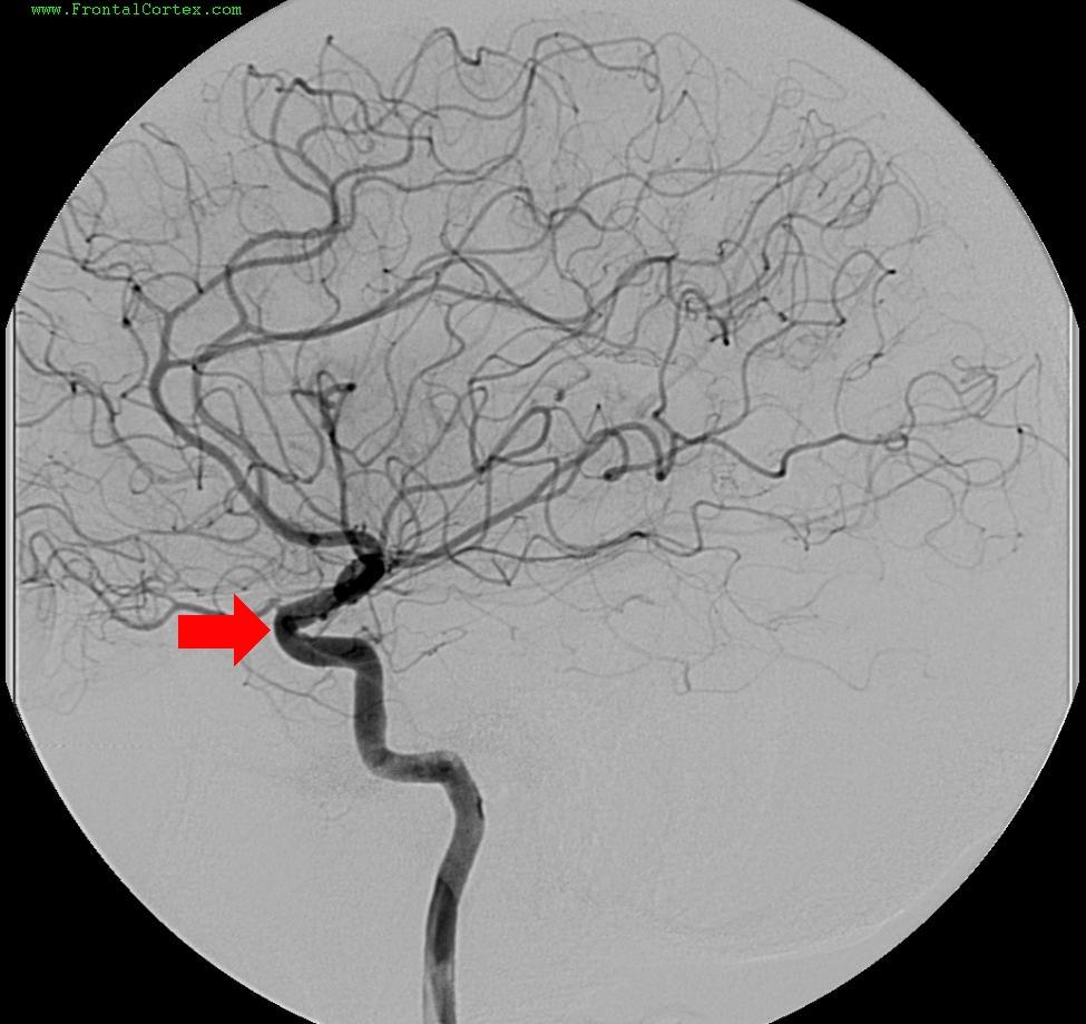 Angiogram ICA Cavernous