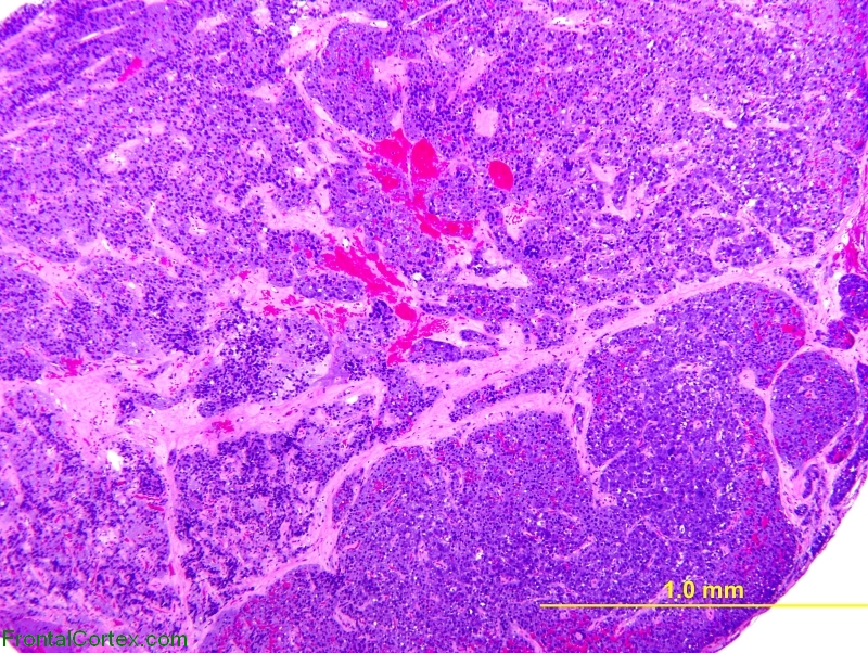 Adenoma 40x