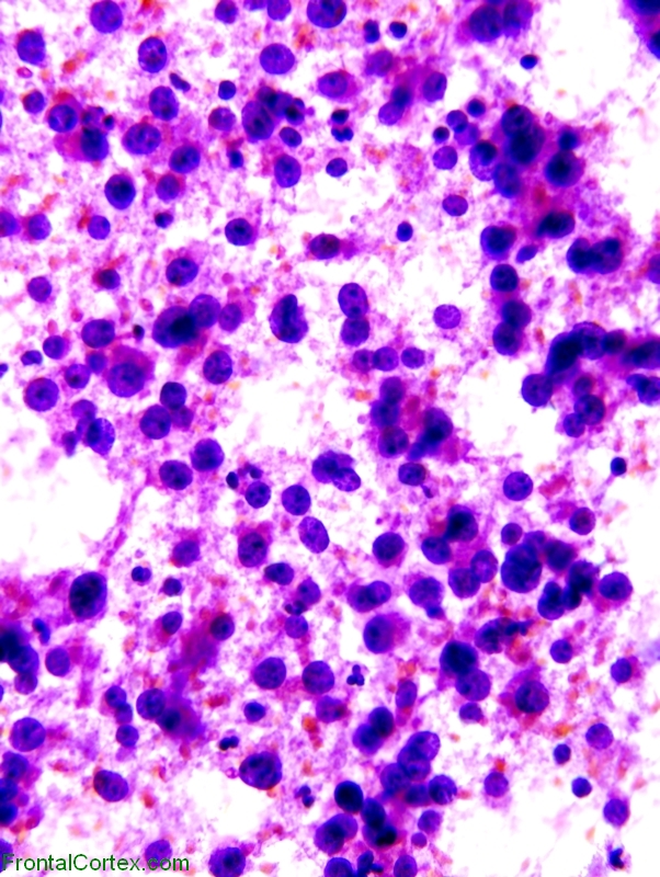 Adenoma Smear 400x