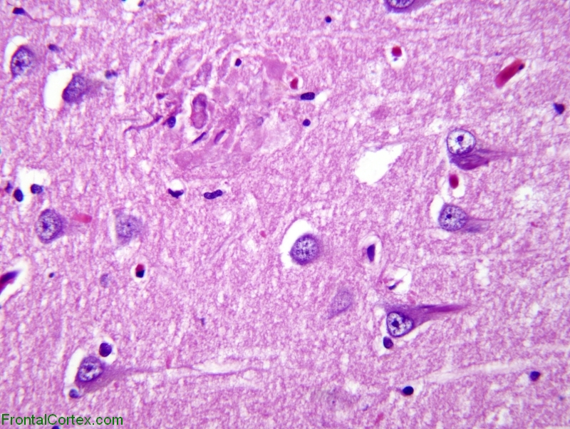 Alzheimer's disease, hippocampus, H&E stain x 400