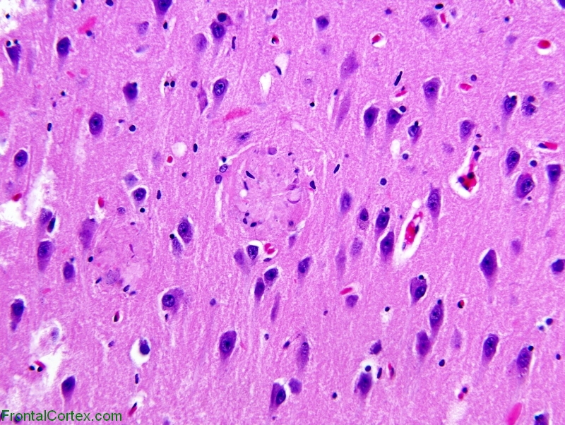 Alzheimer's disease, hippocampus, H&E 200x