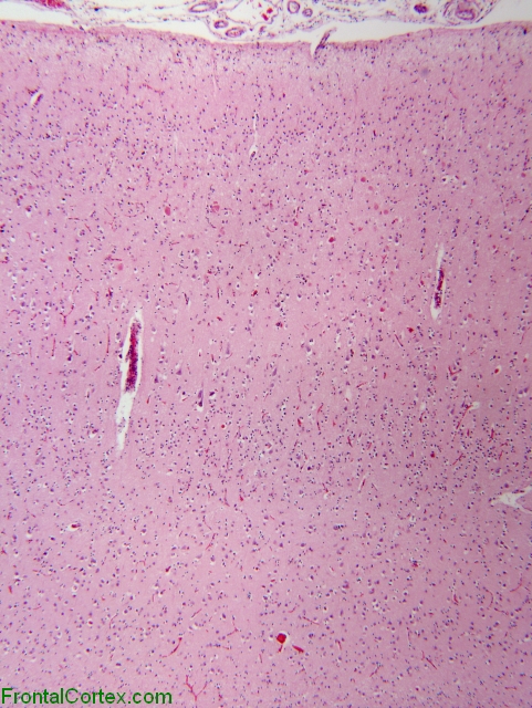 Alzheimer's disease, occipital lobe, H&E stain x40