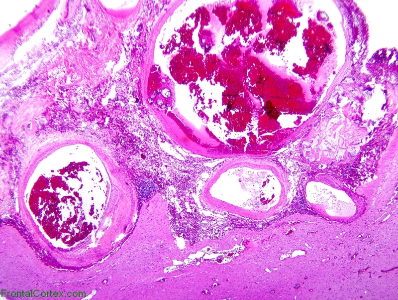 Arteriovenous malformation, H&E stain x 20