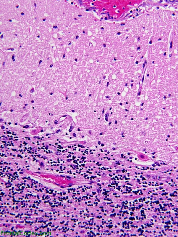Acute Ischemia Cerebellum
