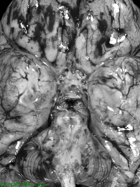 Acute Meningitis