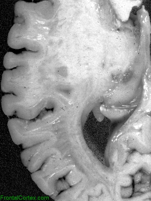 Adrenoleukodystrophy, horizontal section