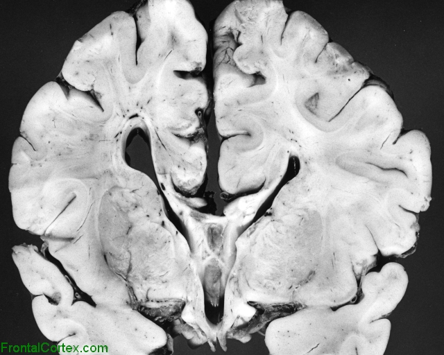 Septo-optic dysplasia, coronal section through brain at the level of the foramen of Monro