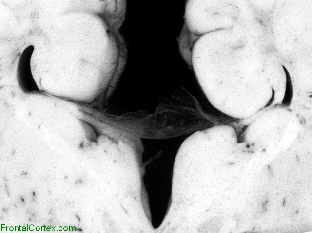 Agenesis of the corpus callosum, coronal section through neonatal brain, close-up