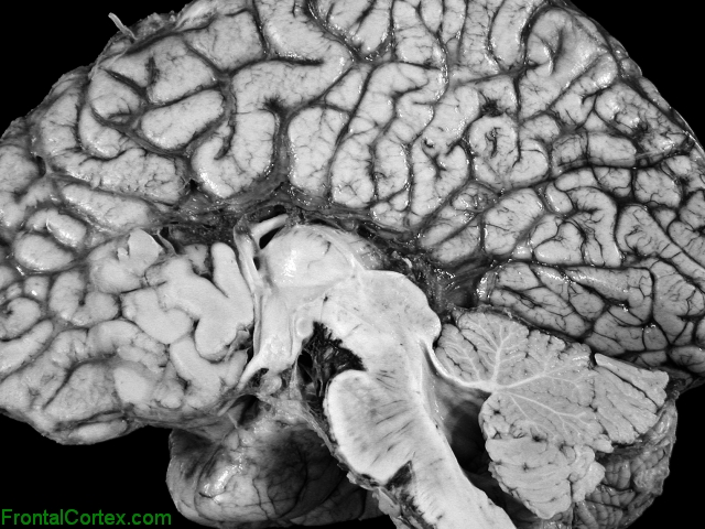 Agenesis of the corpus callosum, mid sagittal section through brain.