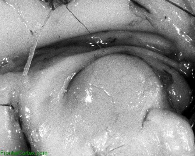 Agenesis of the corpus callosum, mid sagittal section, extreme close-up.