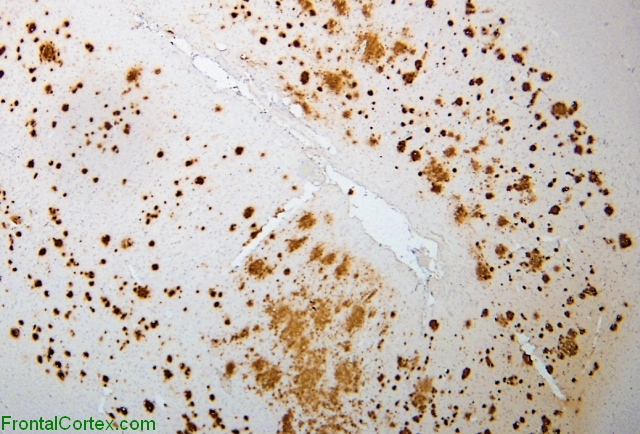 Alzheimer's disease, cerebral cortex, beta amyloid immunohistochemical stain