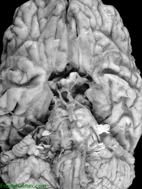 Olfactory nerves and olfactory bulbs