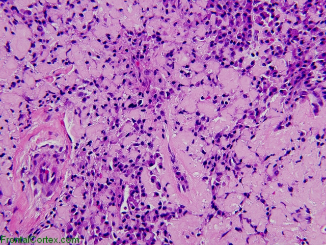 Amyloidotic plasmacytoma, H&E stain x200