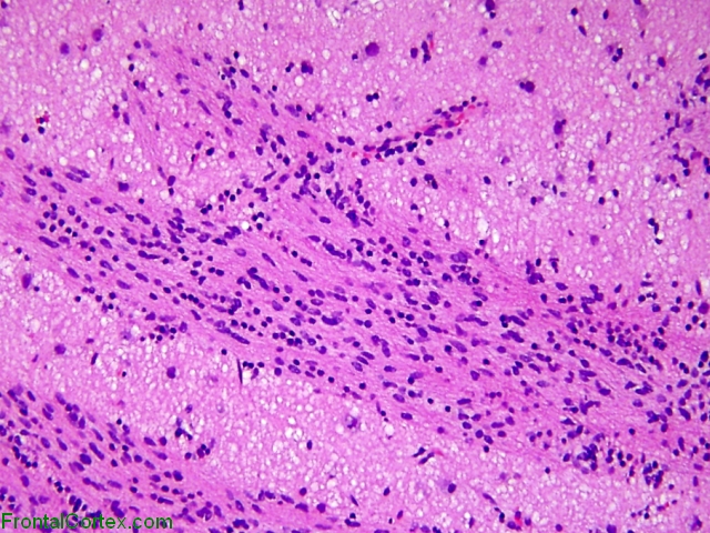 Anaplastic astrocytoma infiltrating corpus striatum, H&E stain x 200