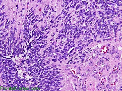 Anaplastic Ependymoma, high power H&E