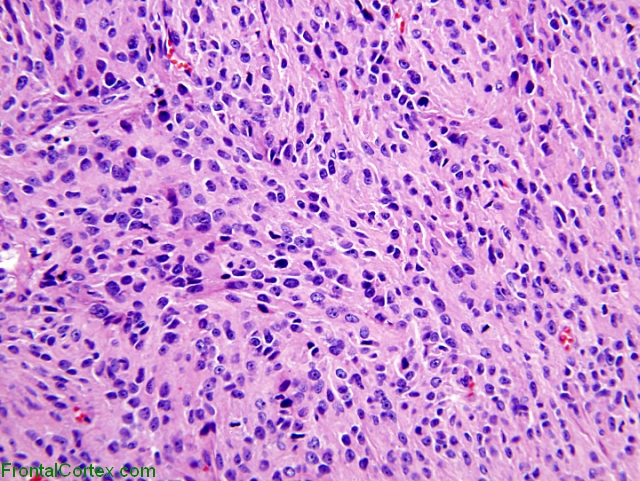 Anaplastic meningioma, H&E stained section