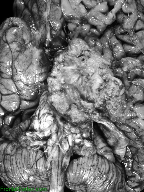 Anaplastic, brain invasive meningioma, ventral surface of brain.