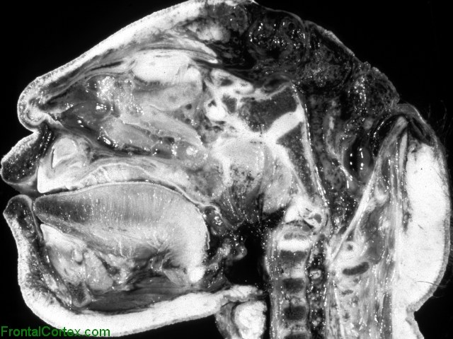 Anencephaly, sagittal section through cranium.