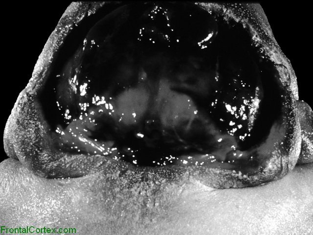 Anencephaly, dorsal view of  cranium