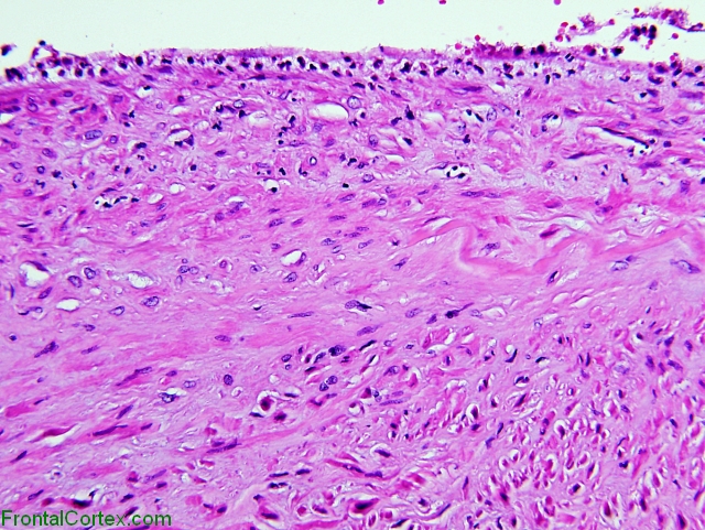 Aneurysm wall, high power H&E stain