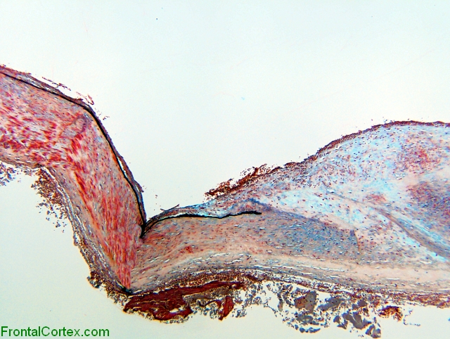 Aneurysm wall, movat pentachrome stain x 40