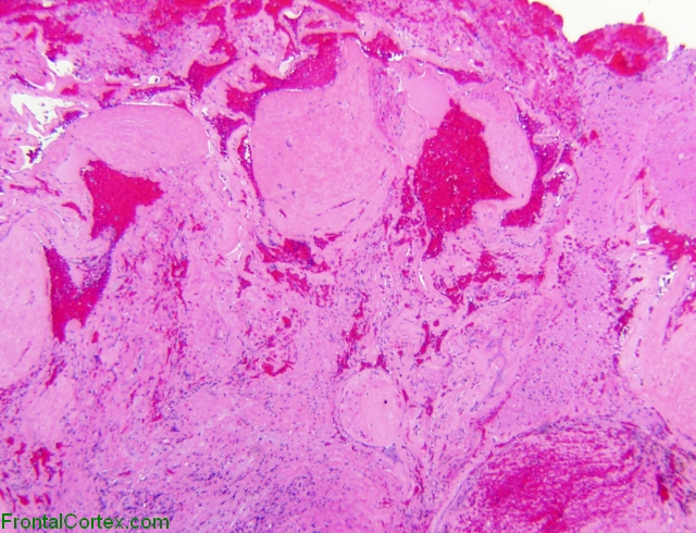 Cavernous angioma, H&E stain slide