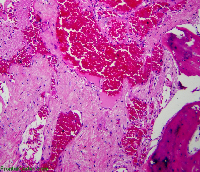 Cavernous angioma with dystrophic ossification, H&E stain x 100