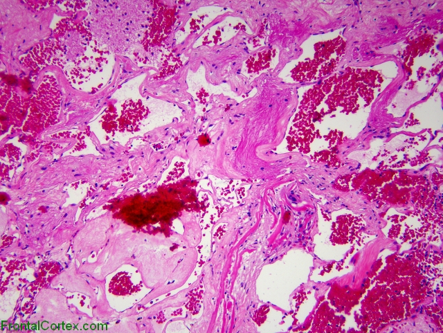 Cavernous angioma, H&E stain x 100