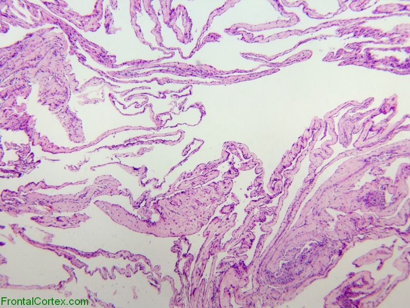 Arachnoid Cyst 40x