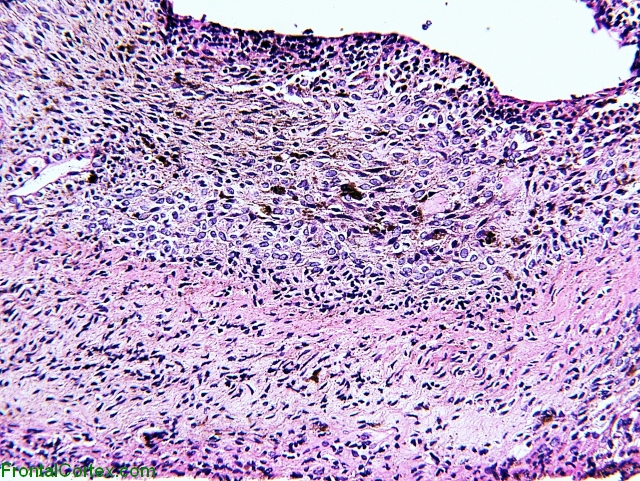 Meningeal melanocytosis, H&E stain x 40