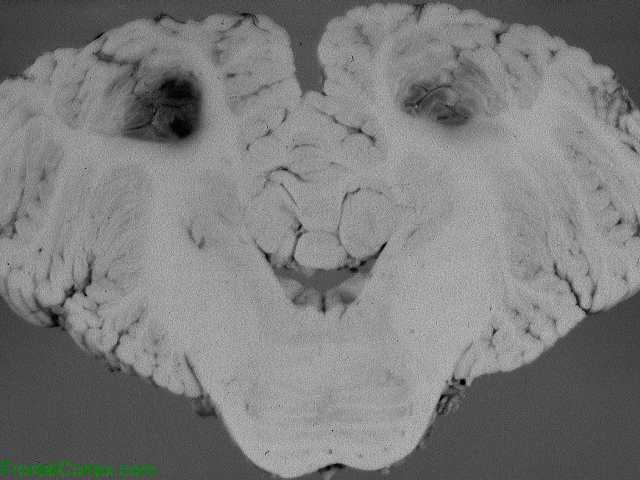 Arterial Border Zone Infarcts, transverse section through cerebellum