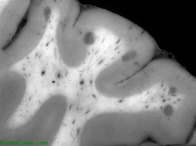 Arterial Border Zone Infarcts, coronal section through cerebral cortex and white matter, close-up