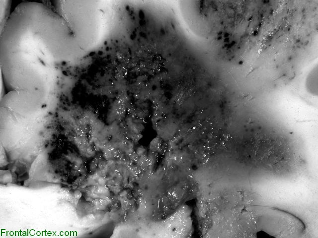 Cerebral aspergillosis, coronal section, close-up.