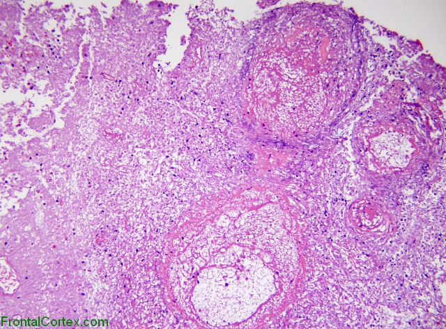 aspergillosis brain