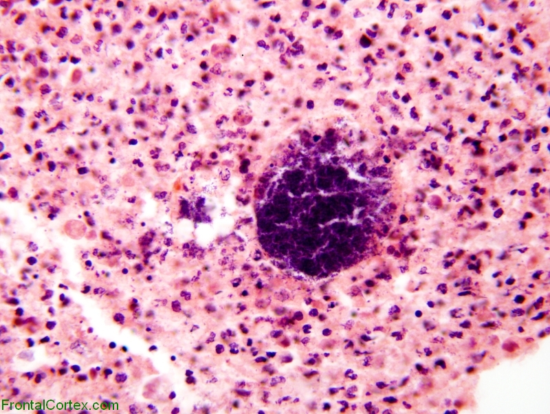 Brain abscess, high power H&E stained section