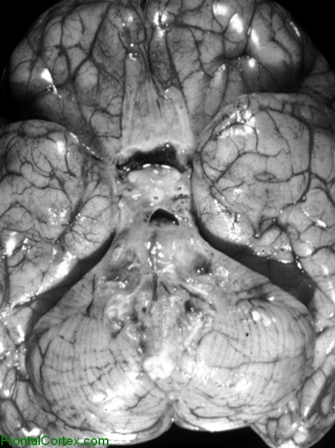 Basilar meningitis, secondary to tuberculous meningeal infection