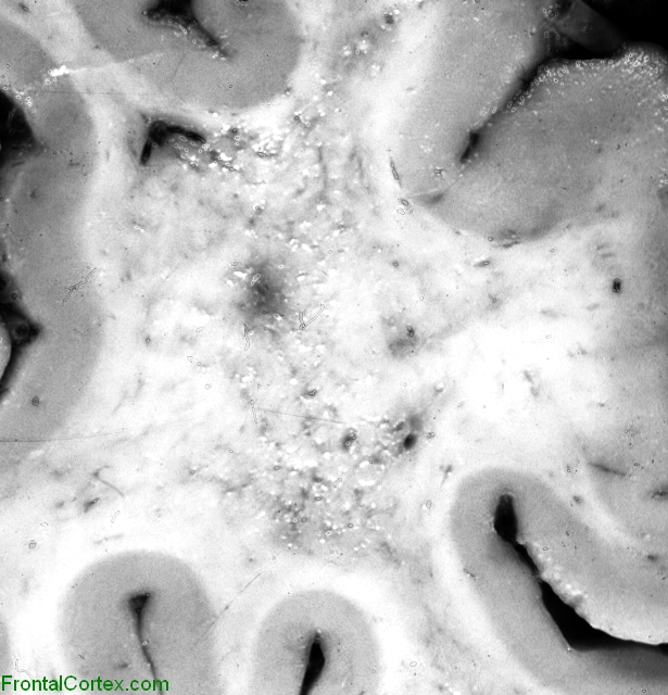 Binswanger disease, coronal section through frontal pole.