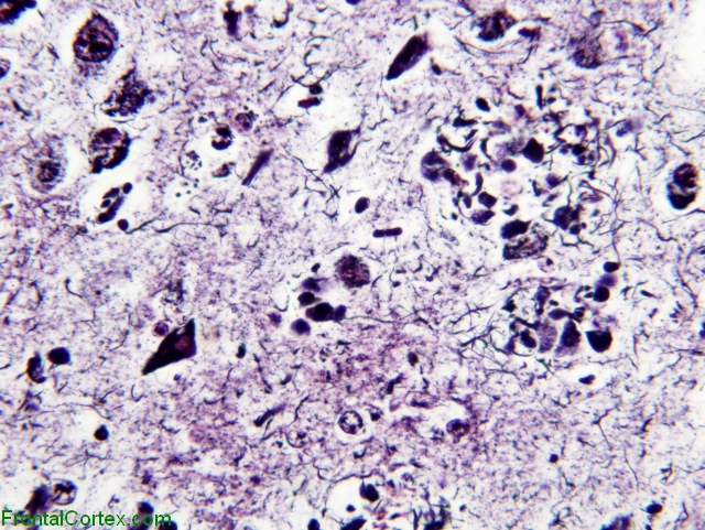 Aged Downs syndrome, hippocampus, Bodian silver stain x 40