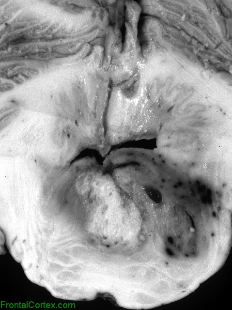 Brainstem Glioma, transverse section