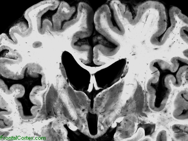 Corticalbasal ganglionic degeneration, coronal section of brain 3 thalamus and basal ganglia.