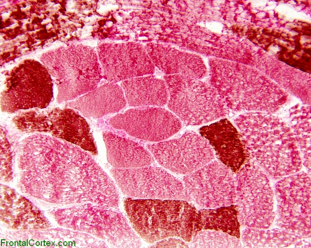 Core myopathy: ATPase stain