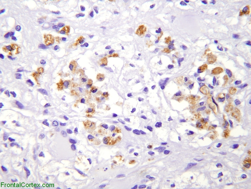 Tumefactive demyelination, immunohistochemical staining for CD68