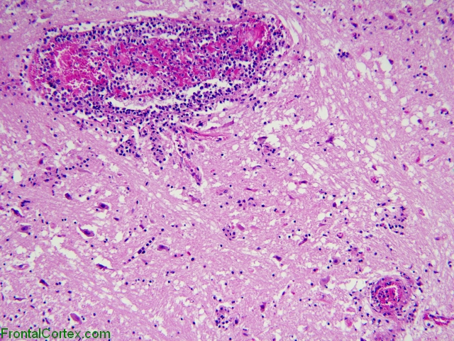 Leptomeningeal and perivascular spread of leukemic cells in a patient with AML, H&E stain x 100