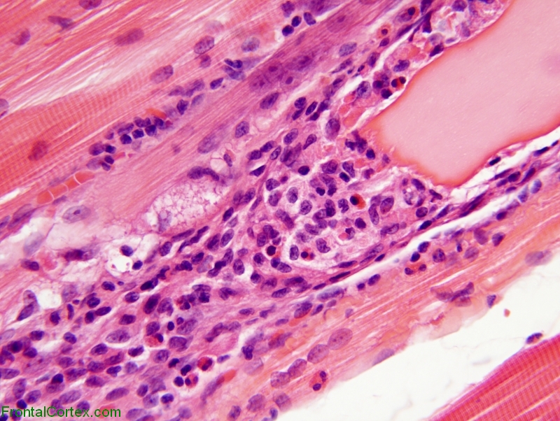 Calpainopathy, paraffin-embedded H&E stained section x 400