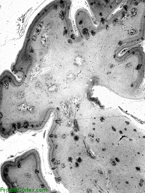 Neonatal cerebral candidiasis, whole mount