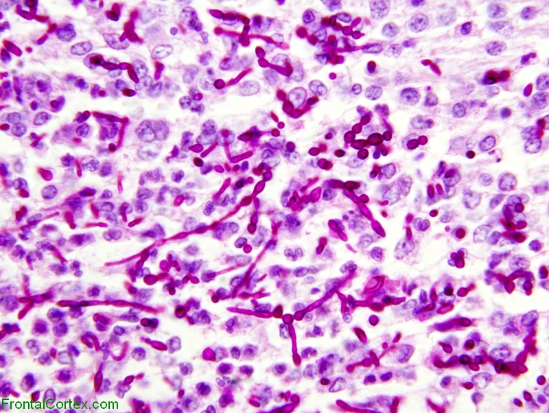 Candidial microabscess, PAS 600x