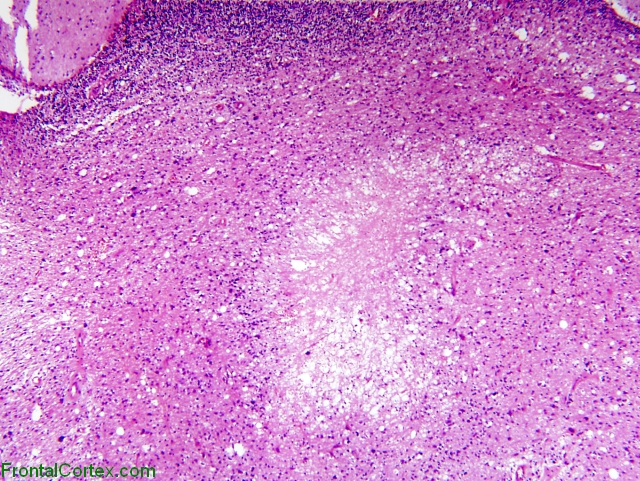 Glioblastoma Multiforme involving cerebellar white matter, H&E Stain X 40