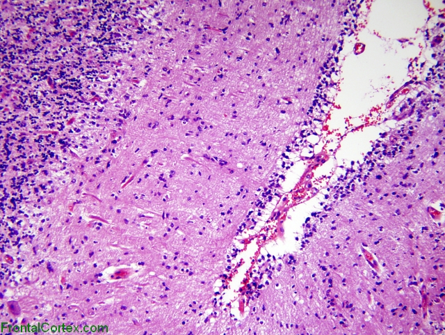 Glioblastoma multiforme involving cerebellum, H&E stain x 100